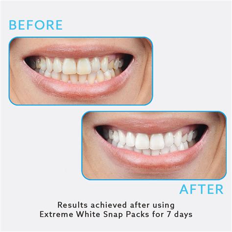 GO SMILE Teeth Whitening On